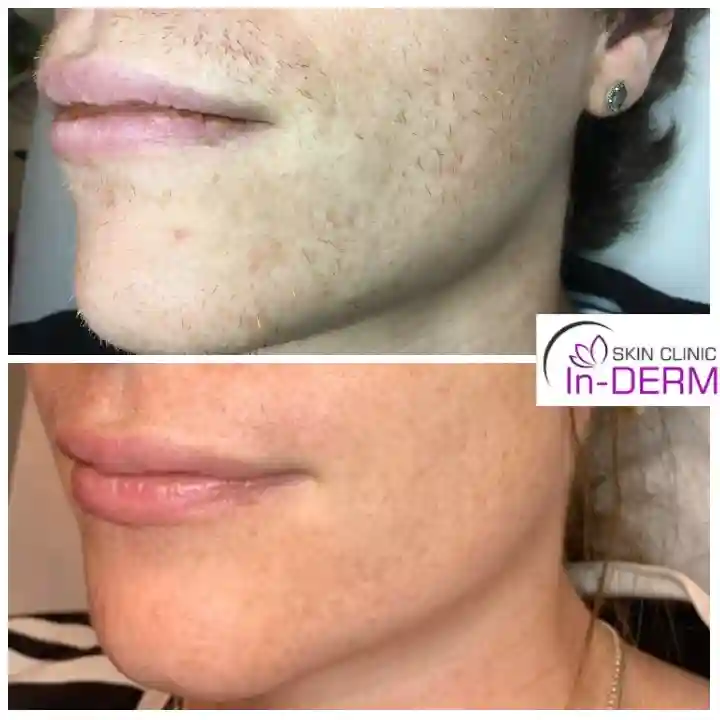 Electrolysis hair removal Before & After