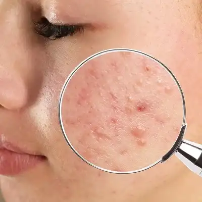 acne skin