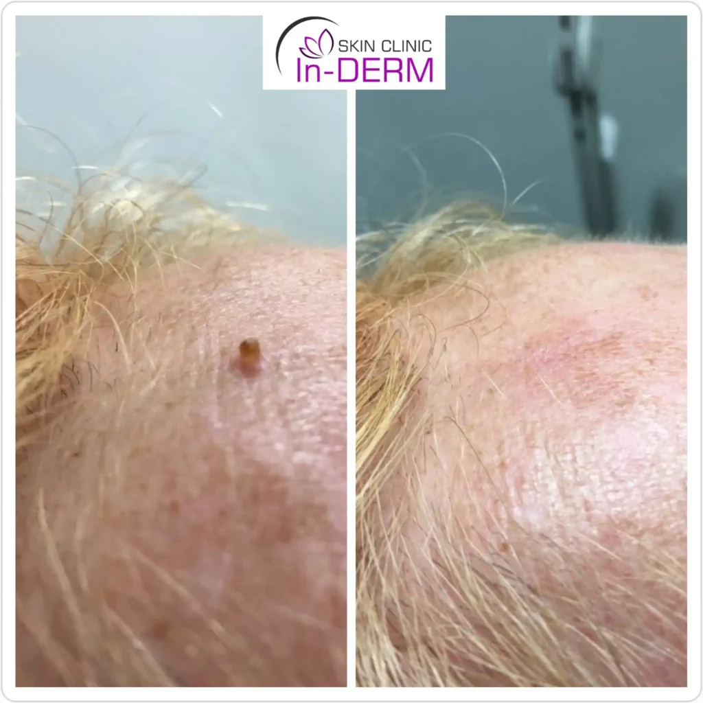 Wart removal before and after on clients forehead