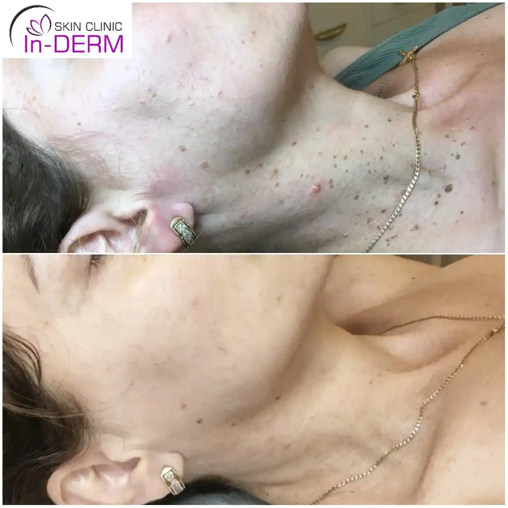 Skin tag and keratosis removal Before & After