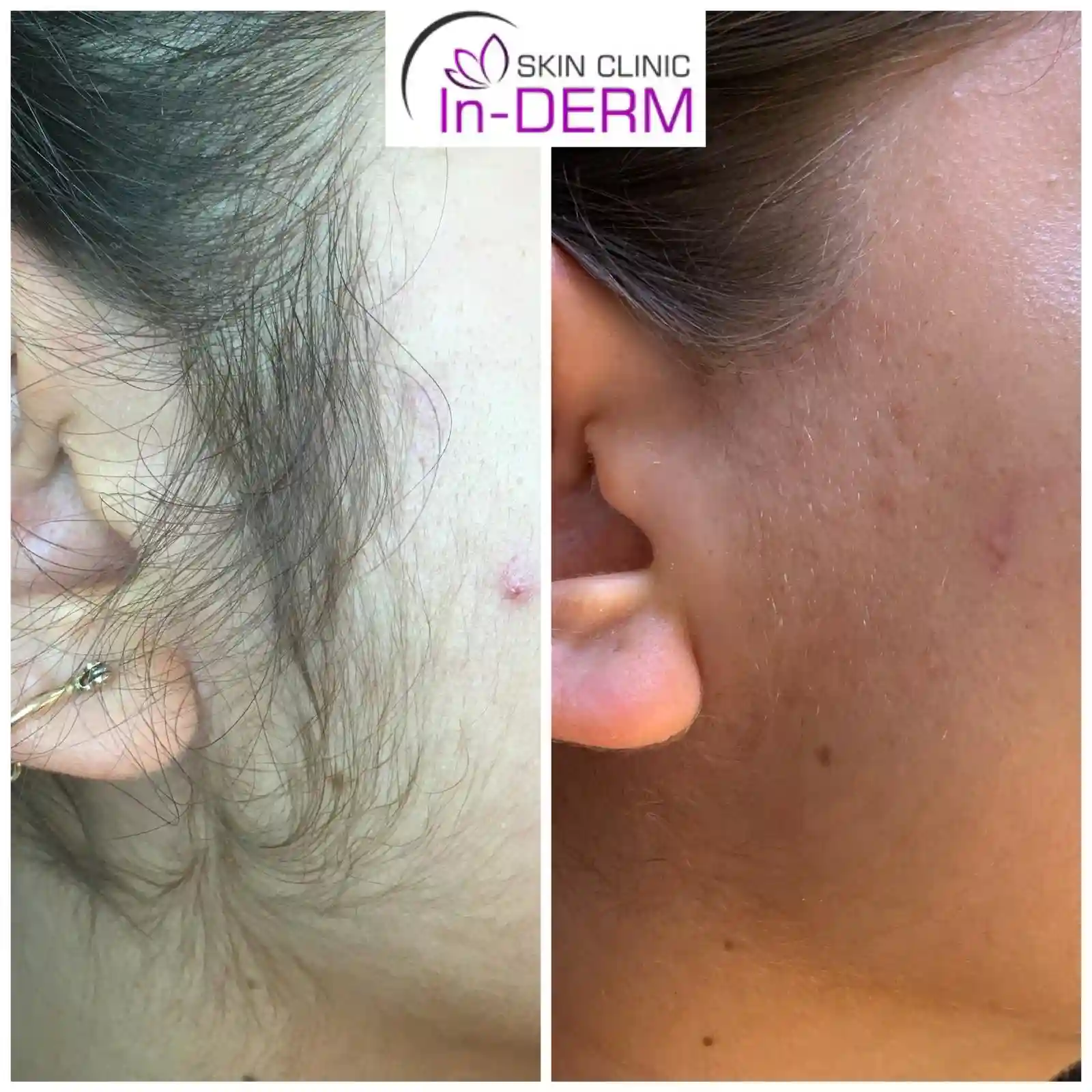 Electrolysis hair removal Before & After