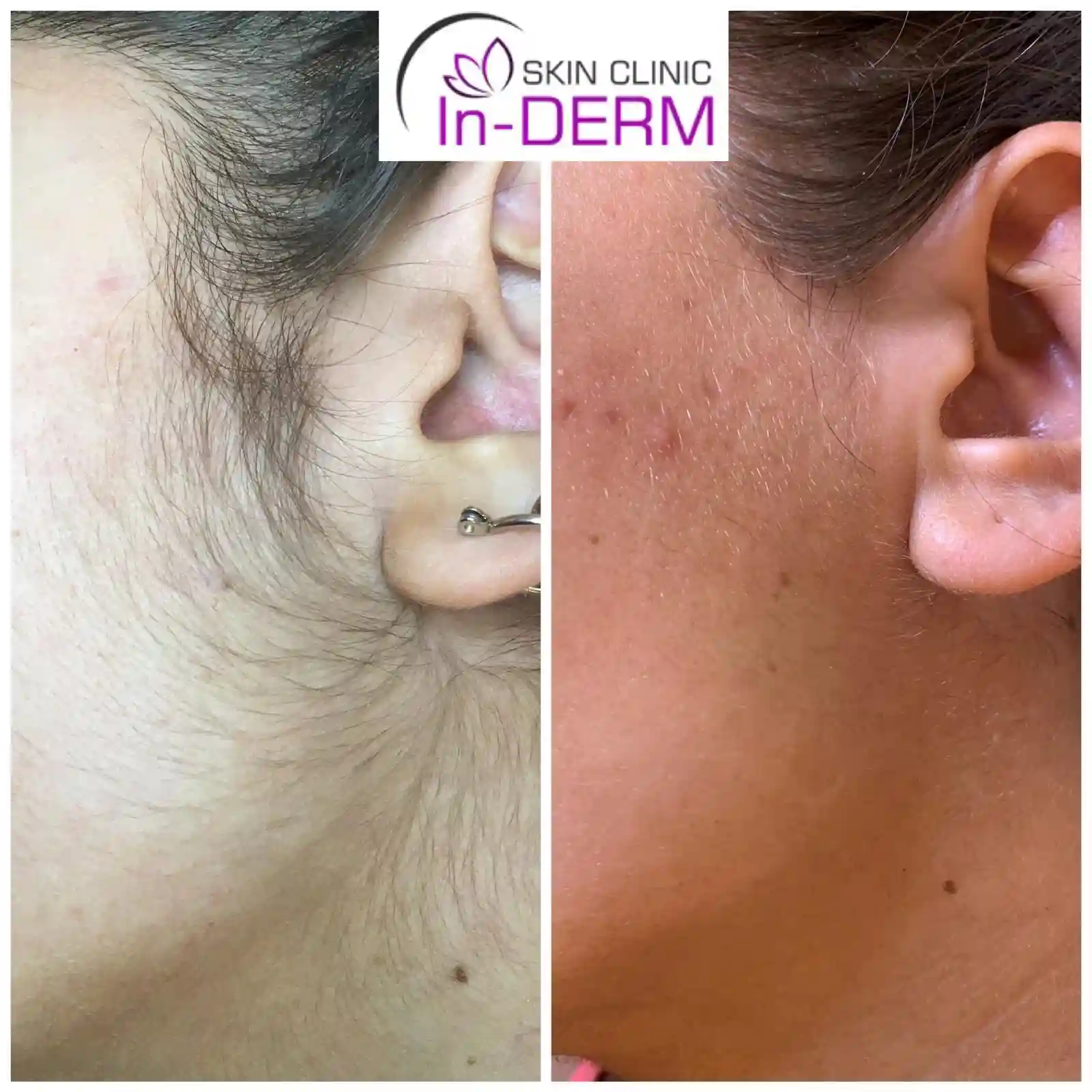 Electrolysis hair removal Before After