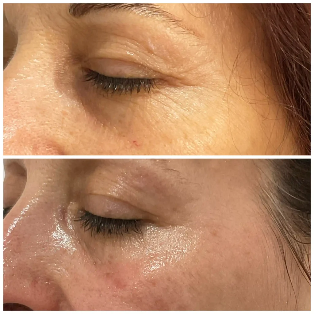 Before and after eye are skin tightening treatment