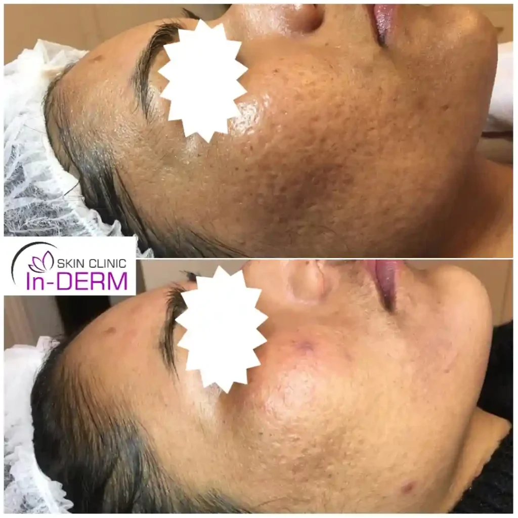 Acne scarring before nd after microneedling London.