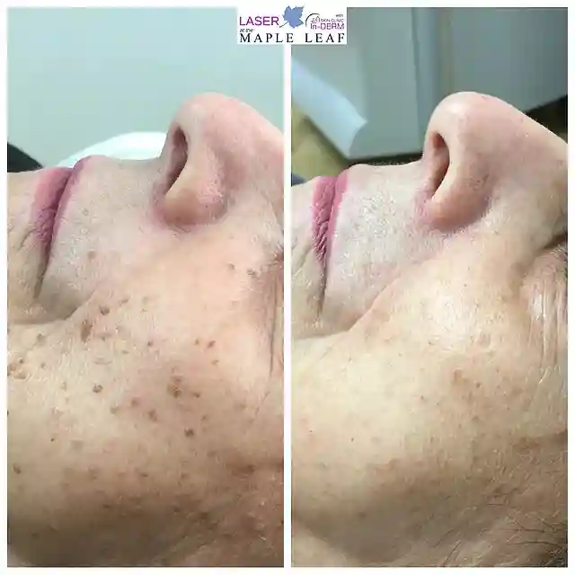Seborheic Keratosis removal Before & After