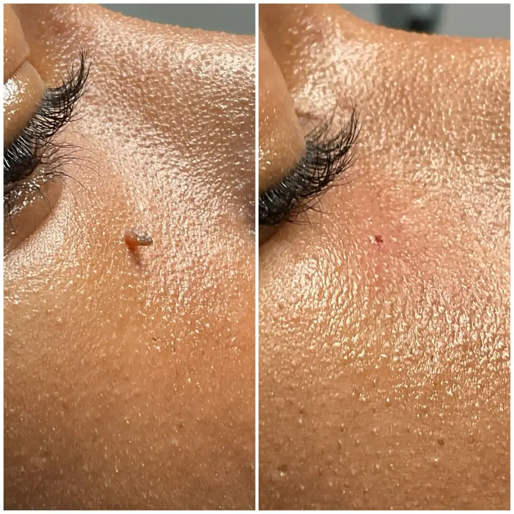 Skin tag removal