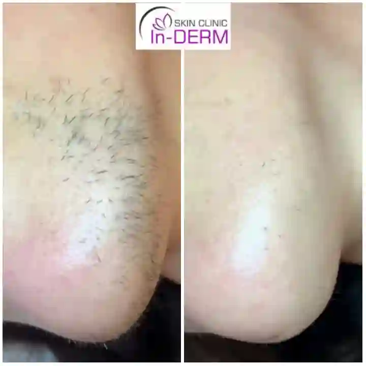 Electrolysis hair removal Before & After