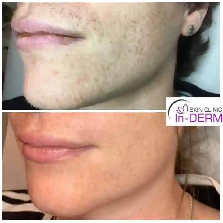 Electrolysis hair removal Before & After