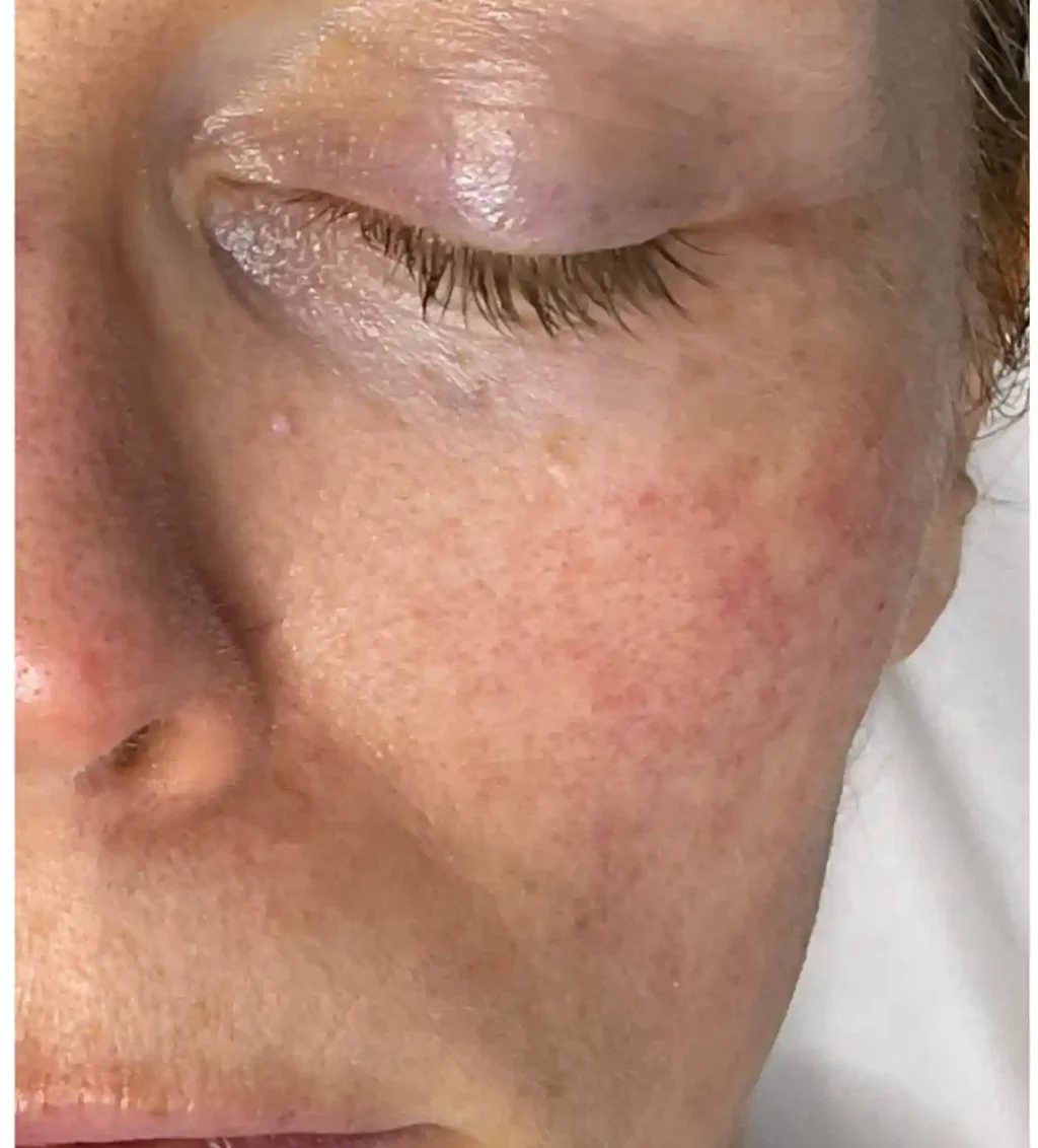 Before Facial treatment